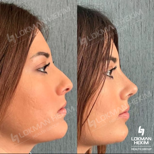 رأب و تجميل الحاجز الأنفي صور قبل وبعد
